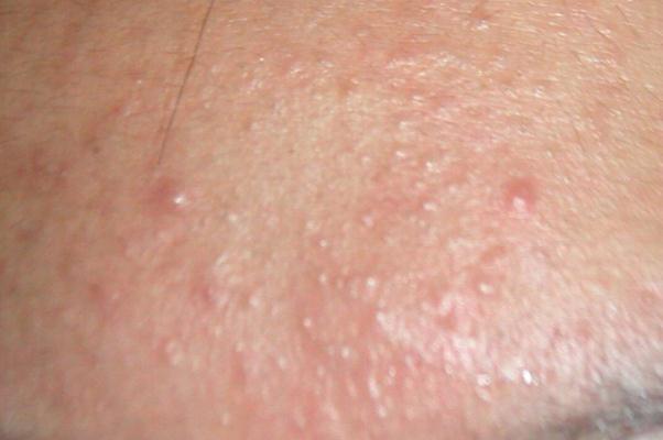 粉刺有硬塊但是擠不出來怎么辦 粉刺會(huì)傳染給別人嗎 粉刺有硬塊但是擠不出來怎么辦 粉刺會(huì)傳染給別人嗎