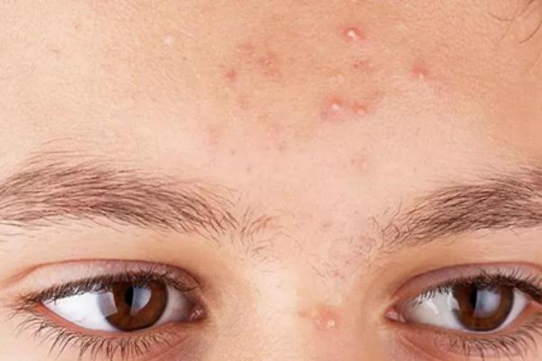 粉刺對身體有什么影響 擠黑頭粉刺會對皮膚有哪些影響