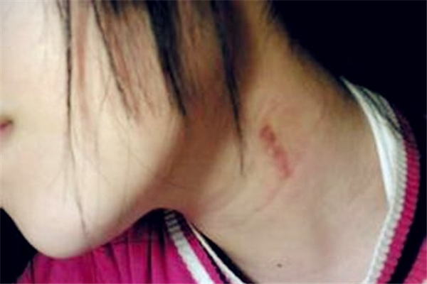 吻痕用雞蛋熱敷管用嗎 吻痕用雞蛋敷過后什么時(shí)候能消 吻痕用雞蛋熱敷管用嗎 吻痕用雞蛋敷過后什么時(shí)候能消