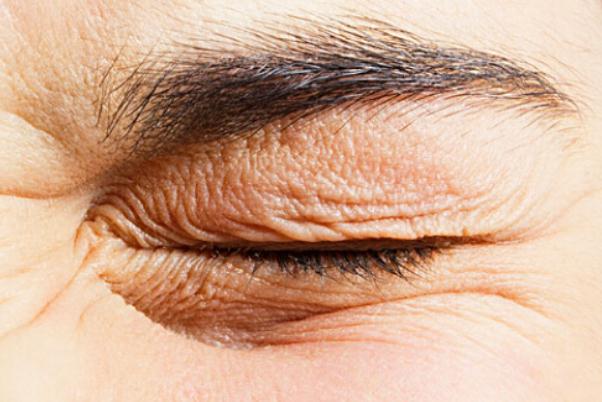 眼部細紋可以熱敷嗎 眼部細紋能淡化嗎