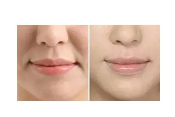 法令紋是氣血虛 法令紋是皺紋嗎 法令紋是氣血虛 法令紋是皺紋嗎