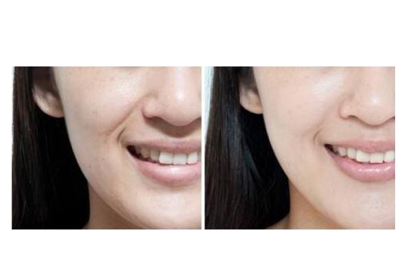 法令紋是氣血虛 法令紋是皺紋嗎 法令紋是氣血虛 法令紋是皺紋嗎