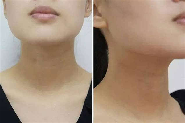 頸紋和胖瘦有關(guān)系嗎 頸紋是因?yàn)榕植庞械膯?><p>頸紋和胖瘦有關(guān)系嗎 頸紋是因?yàn)榕植庞械膯?/p> </a></li>
                           <li><a href=