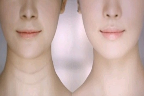 頸紋去除術(shù)一般多少錢(qián) 頸紋特別深怎么去除