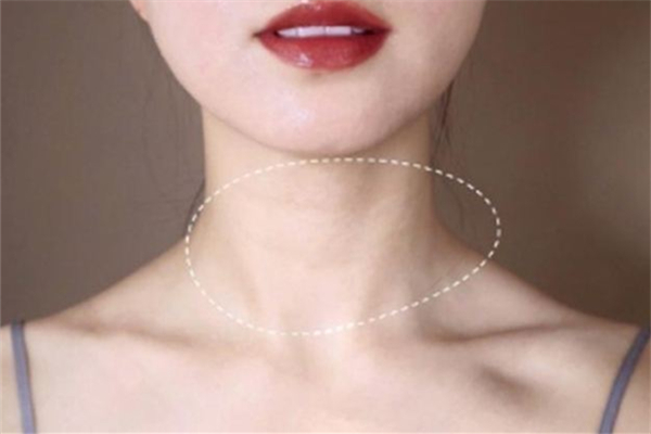 頸紋嗨體注射一次多少錢 頸紋嗨體是什么 頸紋嗨體注射一次多少錢 頸紋嗨體是什么