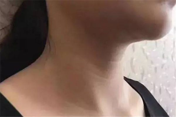 頸紋去除術可以維持多久 頸紋去除術是永久的嗎 頸紋去除術可以維持多久 頸紋去除術是永久的嗎