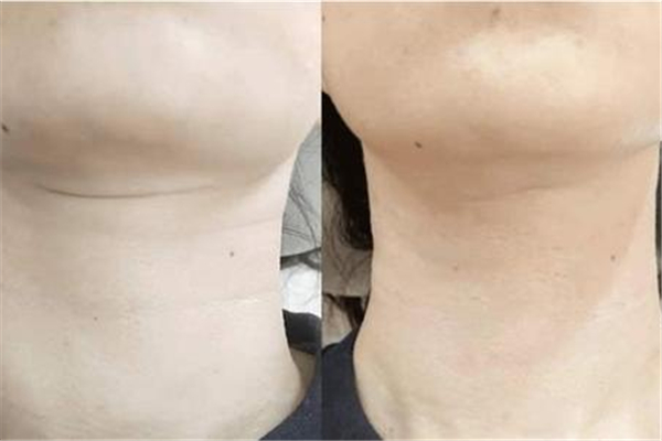 頸紋嗨體注射一次多少錢 頸紋嗨體是什么 頸紋嗨體注射一次多少錢 頸紋嗨體是什么