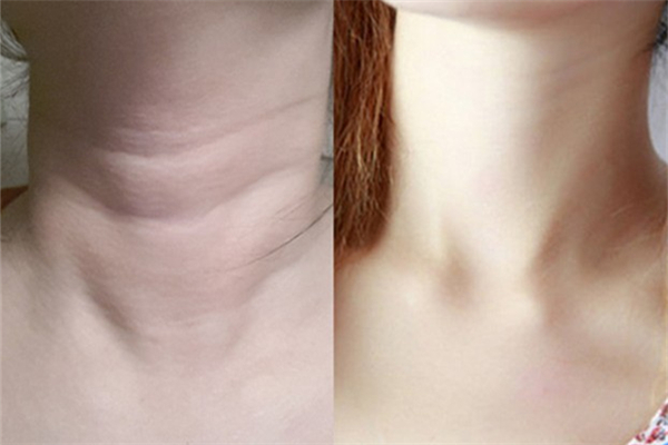 頸紋是怎么引起的 頸紋怎么消除簡單的方法 頸紋是怎么引起的 頸紋怎么消除簡單的方法