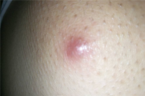 火癤子會(huì)自愈嗎 火癤子長什么樣