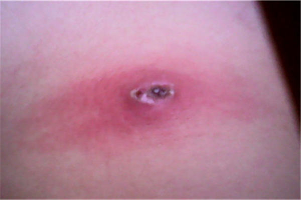 火癤子會(huì)自愈嗎 火癤子長什么樣