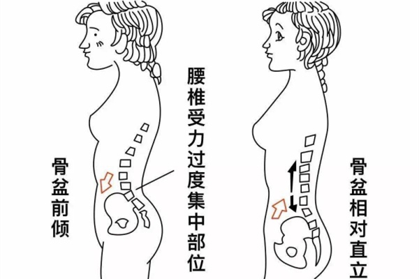 骨盆前傾能矯正過來嗎 骨盆前傾最快糾正法 骨盆前傾能矯正過來嗎 骨盆前傾最快糾正法