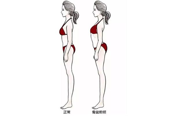 骨盆前傾小肚子會(huì)鼓起來嗎 骨盆前傾小腹突出怎么矯正 骨盆前傾小肚子會(huì)鼓起來嗎 骨盆前傾小腹突出怎么矯正