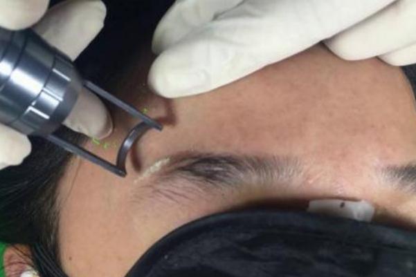 激光洗眉會(huì)留下疤痕嗎 激光洗眉一般需要多少錢(qián) 激光洗眉會(huì)留下疤痕嗎 激光洗眉一般需要多少錢(qián)