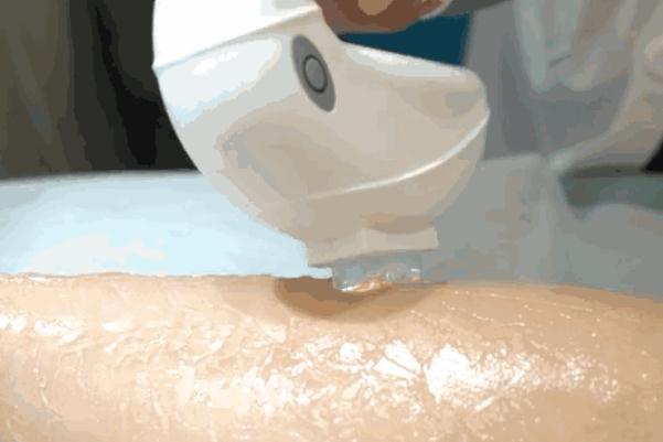 激光脫毛多少錢一次 激光脫毛后悔了 激光脫毛多少錢一次 激光脫毛后悔了