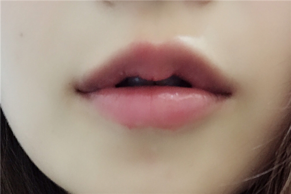 豐唇有多疼 豐唇要注意什么 豐唇有多疼 豐唇要注意什么