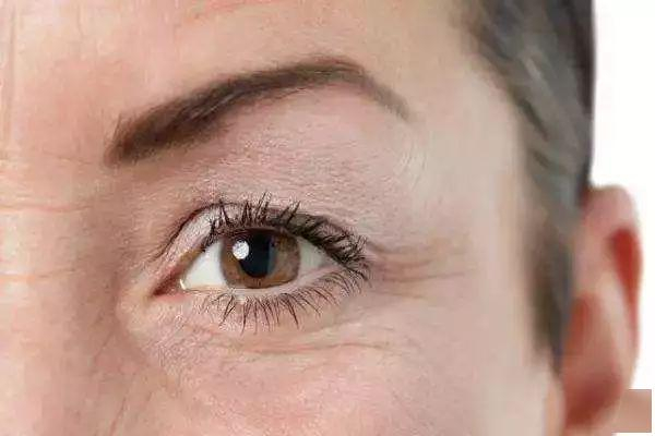 眼部皮膚松弛怎么處理 眼部皮膚松弛是什么原因造成的 眼部皮膚松弛怎么處理 眼部皮膚松弛是什么原因造成的