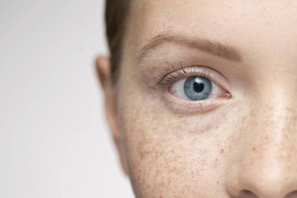 雀斑去除的最佳方法 雀斑能不能徹底根除 雀斑去除的最佳方法 雀斑能不能徹底根除