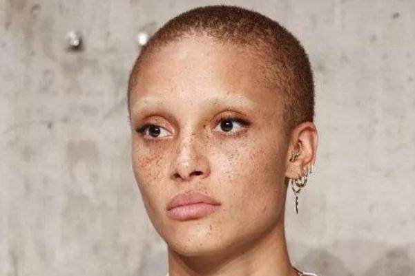 雀斑對身體有影響嗎 雀斑可以做光子嫩膚嗎 雀斑對身體有影響嗎 雀斑可以做光子嫩膚嗎