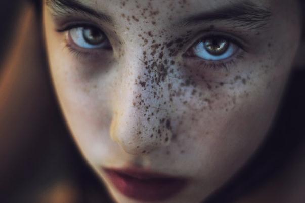 雀斑是遺傳的嗎 雀斑要怎么治療比較好 雀斑是遺傳的嗎 雀斑要怎么治療比較好