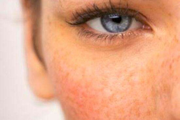 曬斑怎么去除掉 曬斑能徹底根除嗎 曬斑怎么去除掉 曬斑能徹底根除嗎