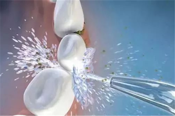 洗牙要多長時間 洗牙會導致牙齦萎縮嗎 洗牙要多長時間 洗牙會導致牙齦萎縮嗎