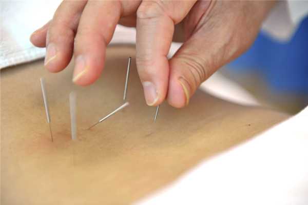 針灸會痛嗎 針灸有多疼