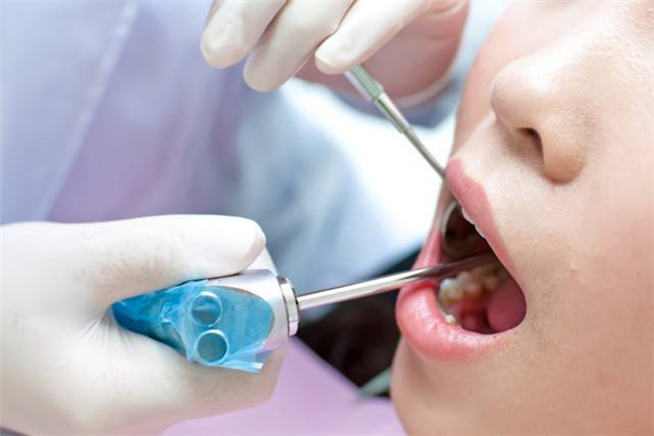 洗牙是掛什么科 洗牙用什么洗的干凈 洗牙是掛什么科 洗牙用什么洗的干凈