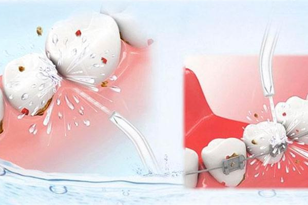 洗牙需要驗(yàn)血嗎 洗牙需要做什么檢查 洗牙需要驗(yàn)血嗎 洗牙需要做什么檢查