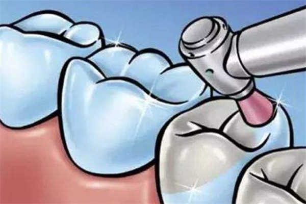 補(bǔ)牙要補(bǔ)幾次才能補(bǔ)好 補(bǔ)牙后需要做牙套嗎