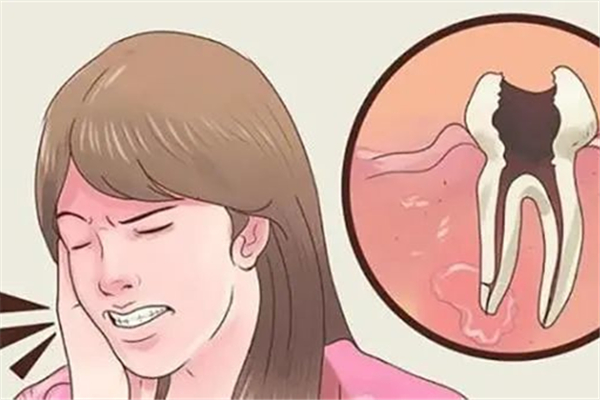 補(bǔ)牙會(huì)不會(huì)破壞里面的神經(jīng) 補(bǔ)牙對(duì)牙齒有傷害嗎 補(bǔ)牙會(huì)不會(huì)破壞里面的神經(jīng) 補(bǔ)牙對(duì)牙齒有傷害嗎