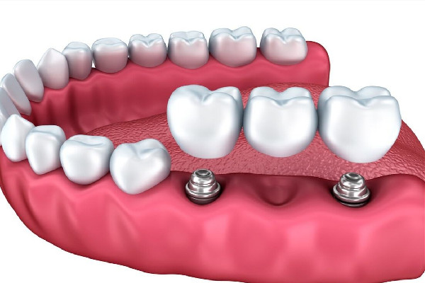 種牙前需要做些什么準(zhǔn)備 種牙前驗血都驗什么 種牙前需要做些什么準(zhǔn)備 種牙前驗血都驗什么