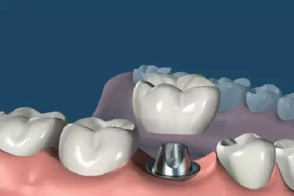 種牙后多長時(shí)間能吃飯 種牙后飲食應(yīng)該注意什么