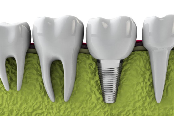 種牙后多長時(shí)間能吃飯 種牙后飲食應(yīng)該注意什么