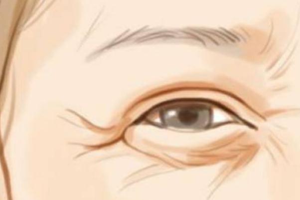 魚(yú)尾紋除皺針打一次能保持多久 魚(yú)尾紋除皺針有什么副作用