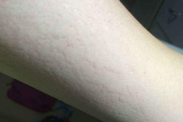 肥胖紋要注意什么 肥胖紋有什么影響嗎 肥胖紋要注意什么 肥胖紋有什么影響嗎