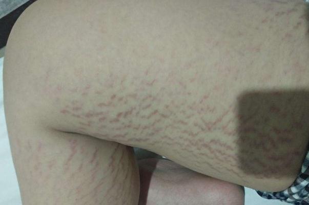 肥胖紋會(huì)自動(dòng)消失嗎 肥胖紋的形成 肥胖紋會(huì)自動(dòng)消失嗎 肥胖紋的形成