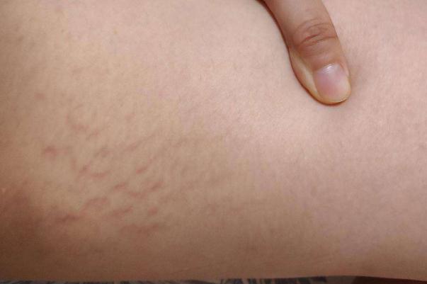 肥胖紋會(huì)自動(dòng)消失嗎 肥胖紋的形成 肥胖紋會(huì)自動(dòng)消失嗎 肥胖紋的形成