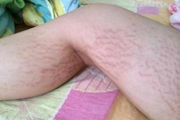 肥胖紋會(huì)自動(dòng)消失嗎 肥胖紋的形成 肥胖紋會(huì)自動(dòng)消失嗎 肥胖紋的形成