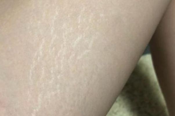 肥胖紋怎么去掉 肥胖紋紅色和白色哪個(gè)更嚴(yán)重 肥胖紋怎么去掉 肥胖紋紅色和白色哪個(gè)更嚴(yán)重