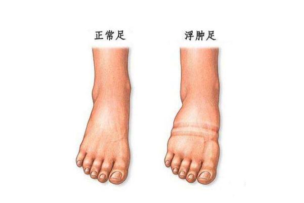 水腫是怎么引起的 水腫怎么治療最快 水腫是怎么引起的 水腫怎么治療最快