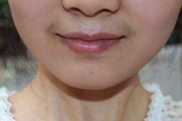 唇毛怎么去除永久 唇毛脫了會(huì)不會(huì)越長越多