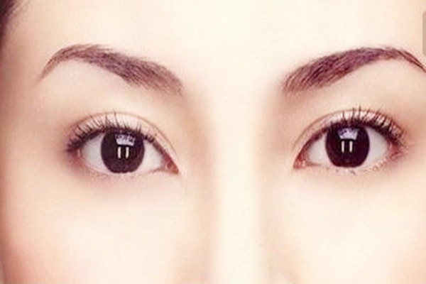 雙眼皮埋線會留疤嗎 雙眼皮埋線會增生嗎 雙眼皮埋線會留疤嗎 雙眼皮埋線會增生嗎