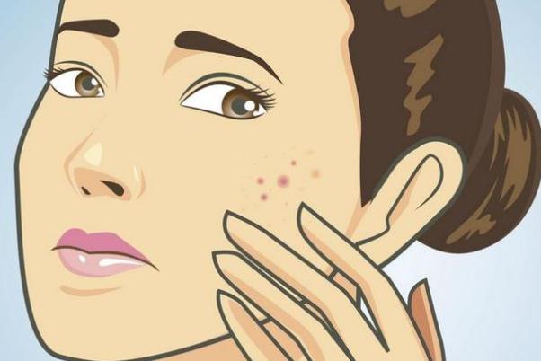痘痘肌膚有哪幾種類型 痘痘肌膚有什么特征 痘痘肌膚有哪幾種類型 痘痘肌膚有什么特征