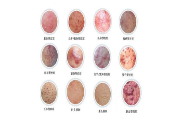 痘痘肌膚怎么修復(fù) 痘痘肌膚適合用什么牌子的護(hù)膚品 痘痘肌膚怎么修復(fù) 痘痘肌膚適合用什么牌子的護(hù)膚品