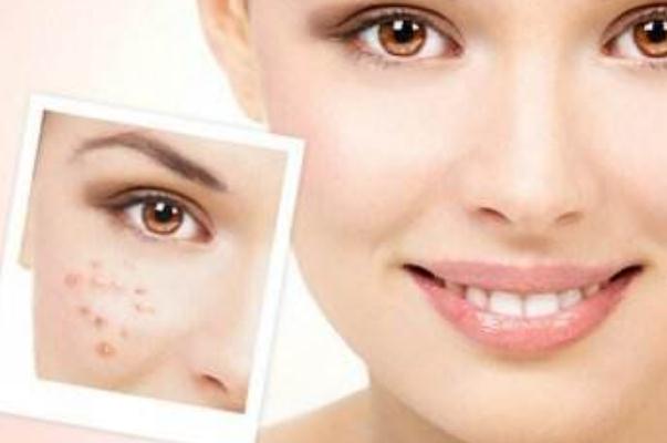 痘痘肌膚要涂防曬嗎 痘痘肌是先補(bǔ)水還是先祛痘 痘痘肌膚要涂防曬嗎 痘痘肌是先補(bǔ)水還是先祛痘