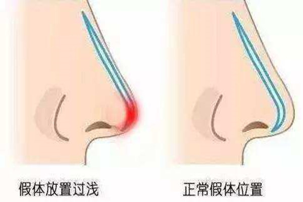 隆鼻要忌口多久 隆鼻可以喝咖啡嗎 隆鼻要忌口多久 隆鼻可以喝咖啡嗎