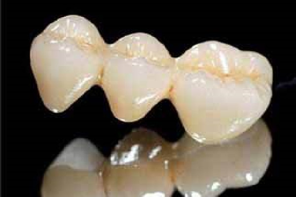 烤瓷牙會(huì)對(duì)原來的牙齒有影響嗎 烤瓷牙的利弊 烤瓷牙會(huì)對(duì)原來的牙齒有影響嗎 烤瓷牙的利弊