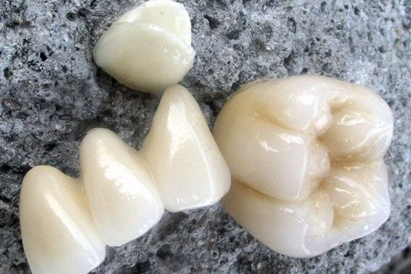 烤瓷牙做完多久能正常吃飯 烤瓷牙會疼嗎 烤瓷牙做完多久能正常吃飯 烤瓷牙會疼嗎