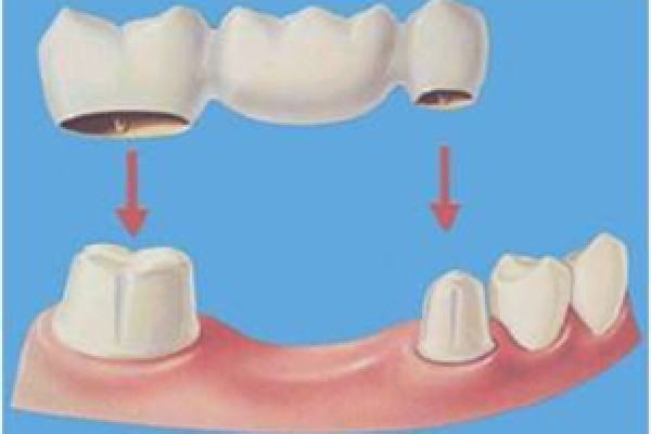 烤瓷牙是什么材料做的 烤瓷牙是什么意思 烤瓷牙是什么材料做的 烤瓷牙是什么意思