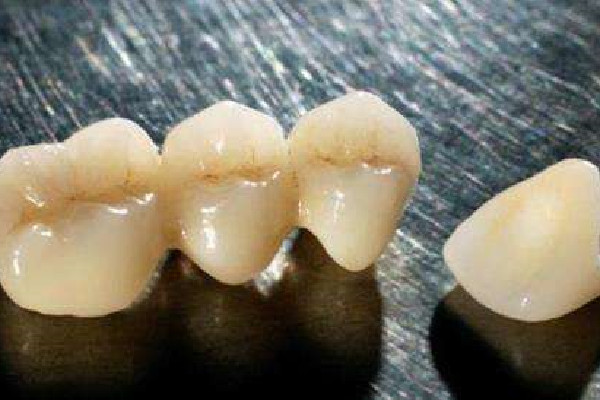 烤瓷牙要把牙齒都拔掉嗎 烤瓷牙有金屬嗎 烤瓷牙要把牙齒都拔掉嗎 烤瓷牙有金屬嗎